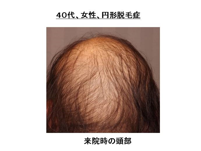 円形脱毛症　病院""